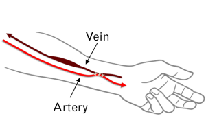 Fistula diagram